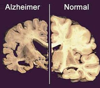 Alzheimer