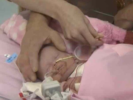 Bambina nata con il cuore fuori dal corpo, ora sta bene