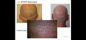 Le comuni tecniche di trapianto capelli: FUT (Strip) e F